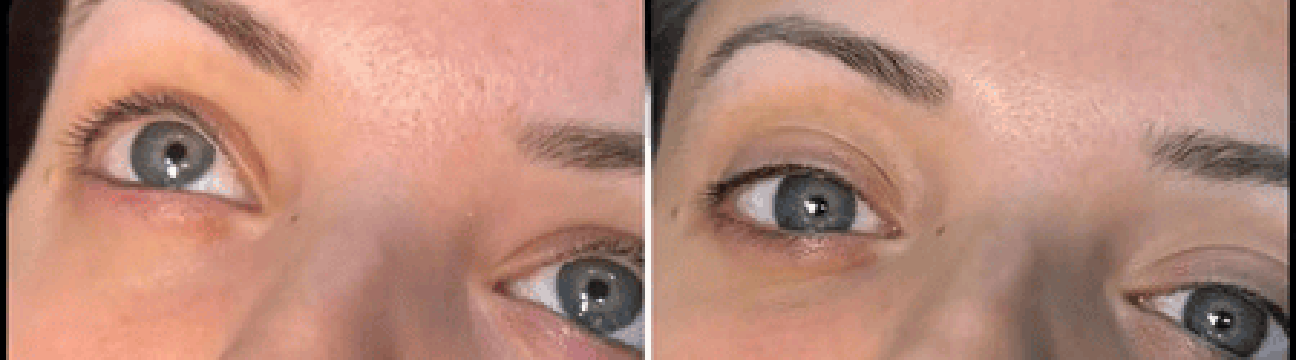 Dermal Fillers